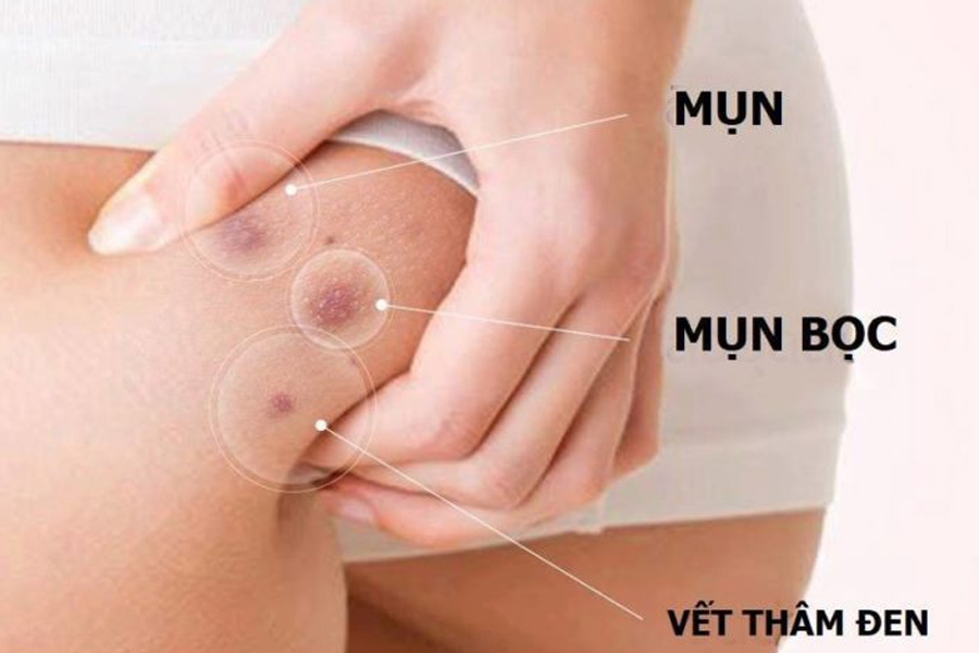 Truy tim 6 nguy nhan khien mun hay moc o mong cua ban 2